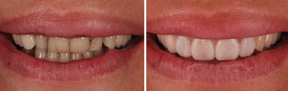 mockup-dental-mejorar-sonrisa-caso-clinico-3