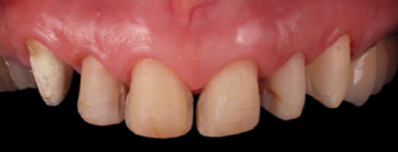 mockup-dental-mejorar-sonrisa-caso-clinico-6