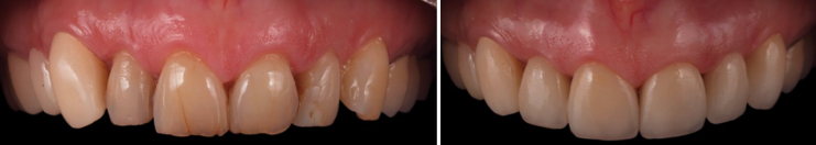 mockup-dental-mejorar-sonrisa-caso-clinico-7