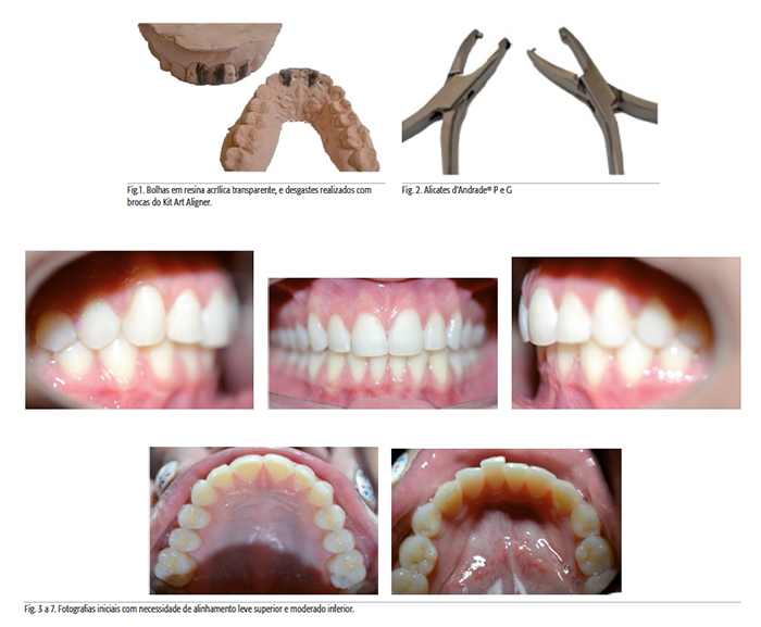 ortodoncia-alineadores-invisibles-2