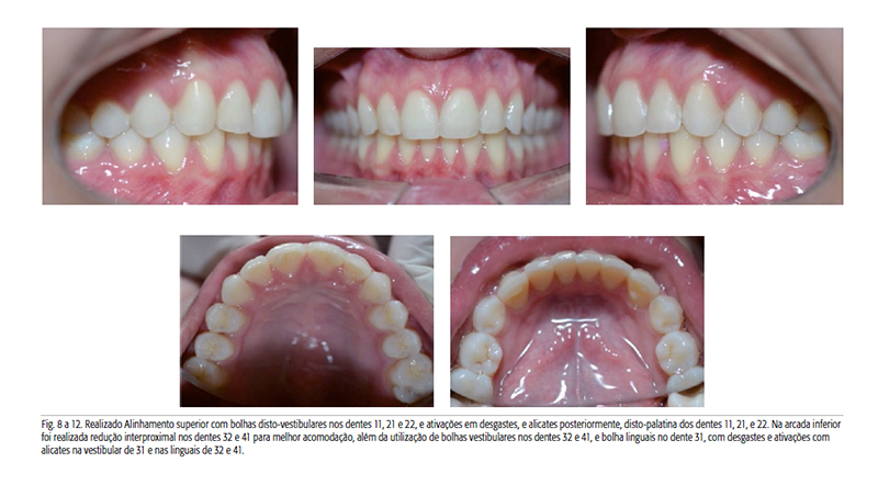 ortodoncia-alineadores-invisibles-3