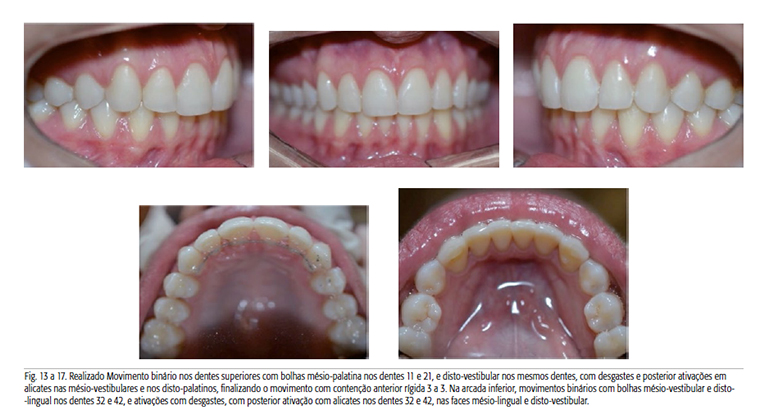 ortodoncia-alineadores-invisibles-4