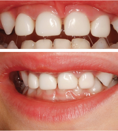 Figure 2 –A: Clinical photograph one week after treatment under GA. Notice the excellent fit of the crowns and the healthy gums. B: Lateral view taken at the same date showing good occlusion at the canine area.