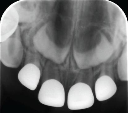 Figure 4: Radiograph of the traumatized lateral incisor. Slight enlargement of the PDL confirms the diagnosis of lateral luxation