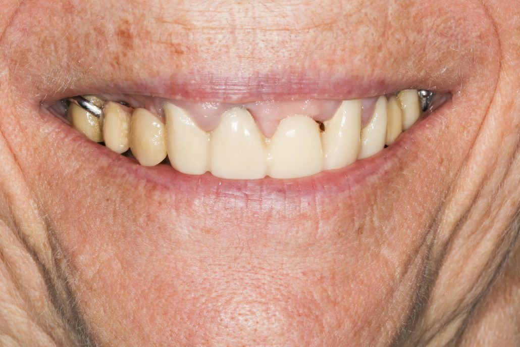 Peri-implantitis : Diseases that cause loss of bone around the dental implant