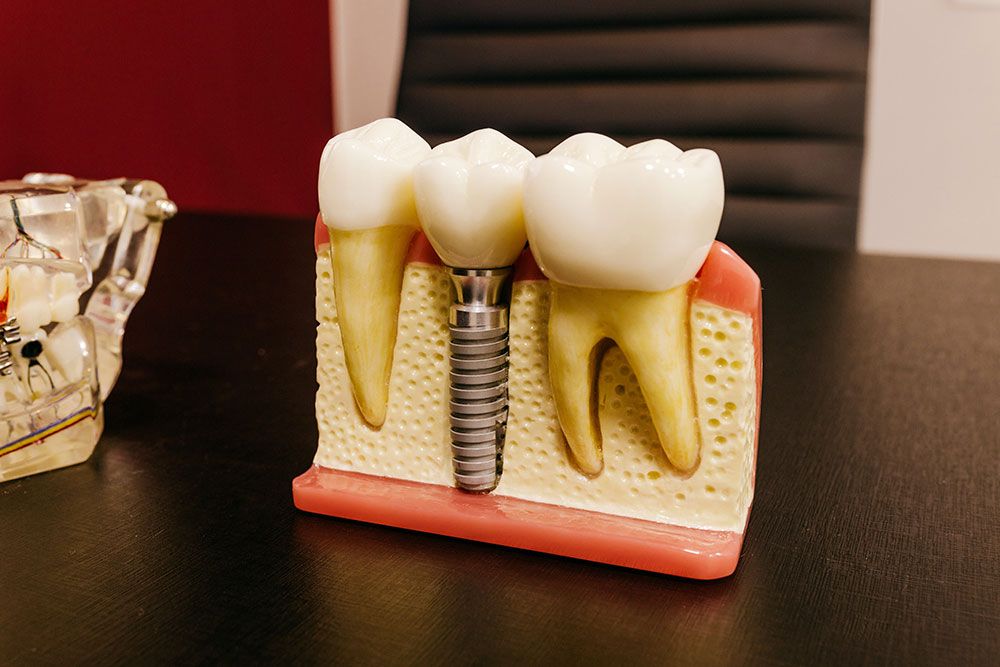 causas-de-rechazo-de-implantes-dentales