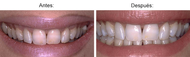 formacion-estetica-dental-blanqueamiento-5