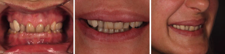 mockup-dental-mejorar-sonrisa-caso-clinico-1