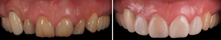 mockup-dental-mejorar-sonrisa-caso-clinico-4