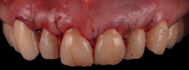 mockup-dental-mejorar-sonrisa-caso-clinico-5