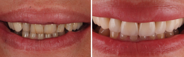 mockup-dental-mejorar-sonrisa-caso-clinico-8