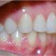 ortodoncia-alineadores-invisibles-5