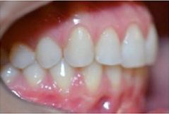 ortodoncia-alineadores-invisibles