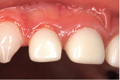 Figure 5: Clinical photo of the traumatized lateral incisor two months post trauma. The injury has been resolved. Gingival tissue looks healthy and the zirconia crown is esthetic and stable.