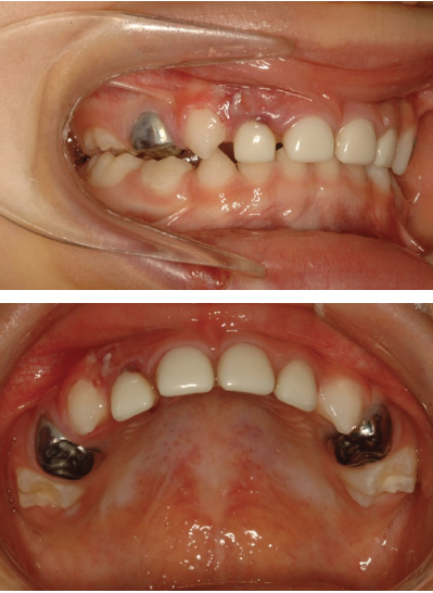 Figure 3- A: Post treatment photograph taken immediately after a traumatic injury 45 days after the GA treatment. Notice swelling and laceration of the gum above the right maxillary lateral incisor. B: General view of the restored maxillary arch at the day of the injury. Notice the inflammation of the gingiva of the right primary lateral incisors and the plaque accumulation over the SSC on the affected side due to improper brushing and sensitivity.