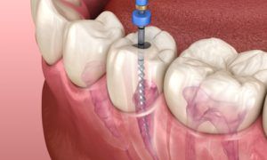 Curso de endodoncias