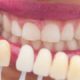 como-se-ponen-las-carillas-dentales (1) (1)