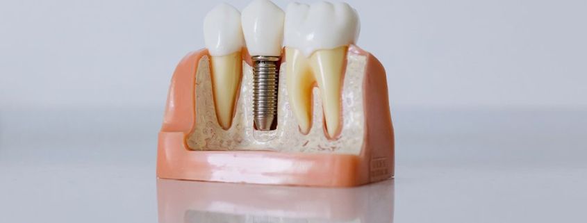Signos de rechazo de implantes dentales